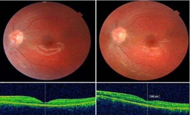 کشف 45 ژن جدید مرتبط با نابینایی